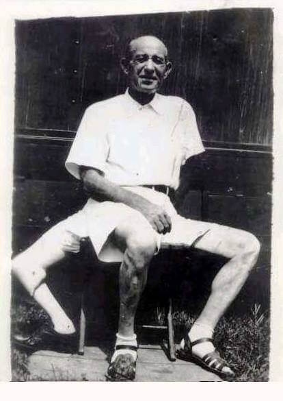 Трёхногий человек. Франческо Лентини обладатель очень редкой аномалии развития из острова Сицилия. Он родился в 1889 году с тремя ногами и двумя половыми органами, зарабатывал на жизнь, работая